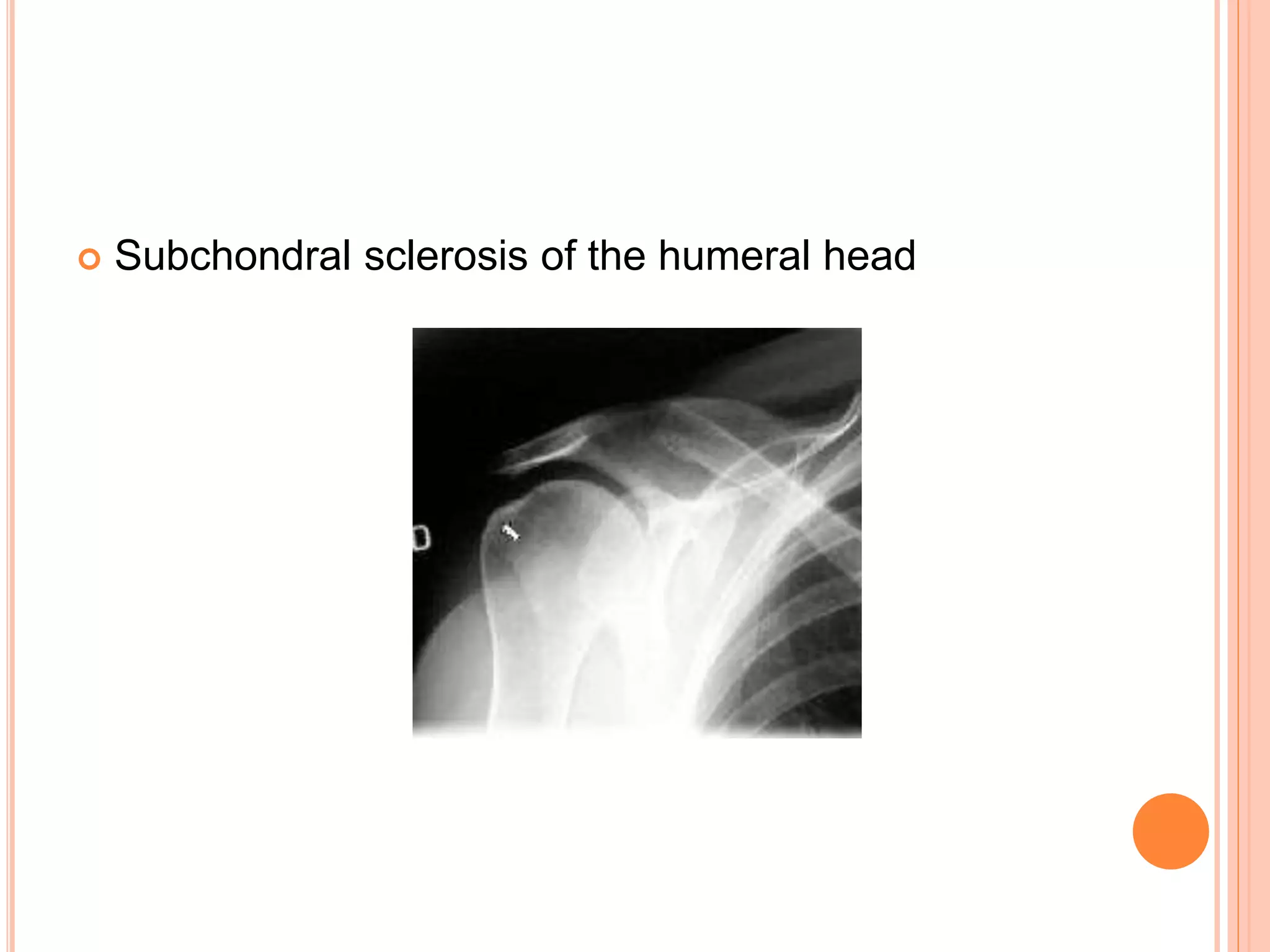  Subchondral sclerosis of the humeral head
 