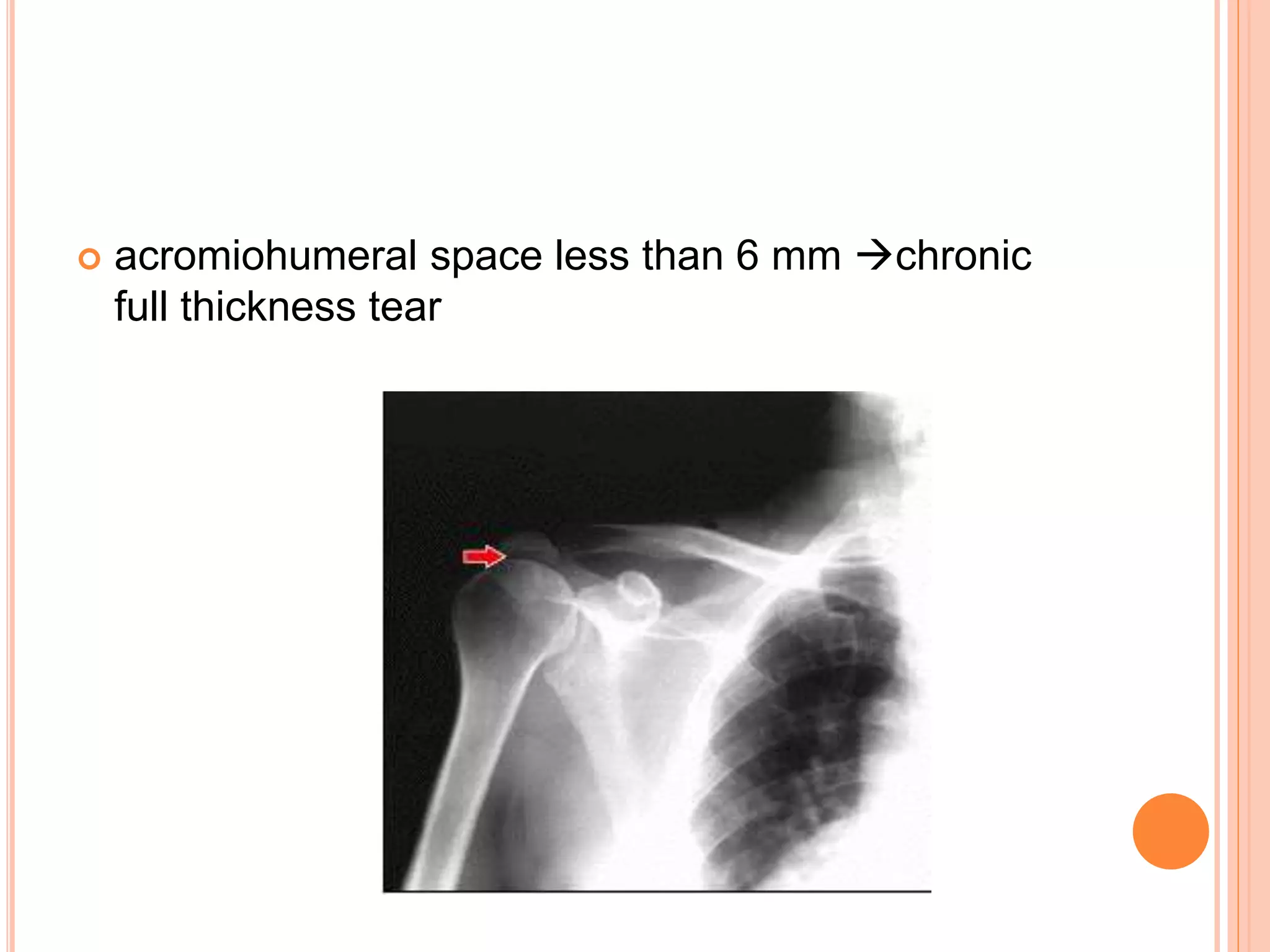 acromiohumeral space less than 6 mm chronic
full thickness tear
 