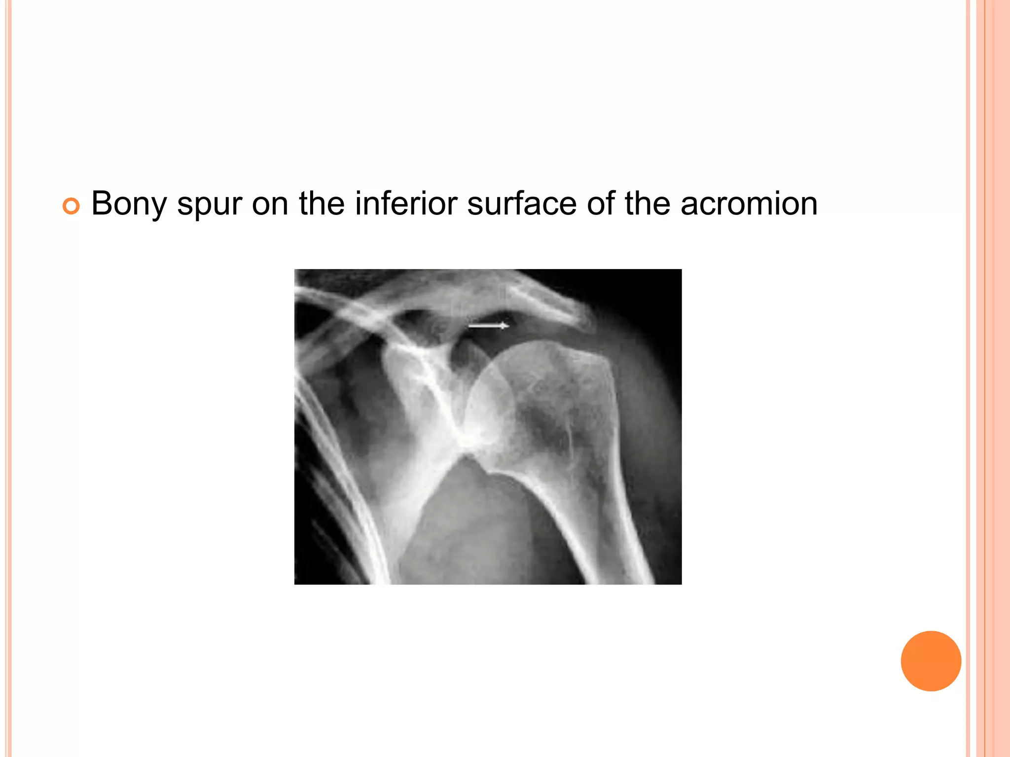  Bony spur on the inferior surface of the acromion
 