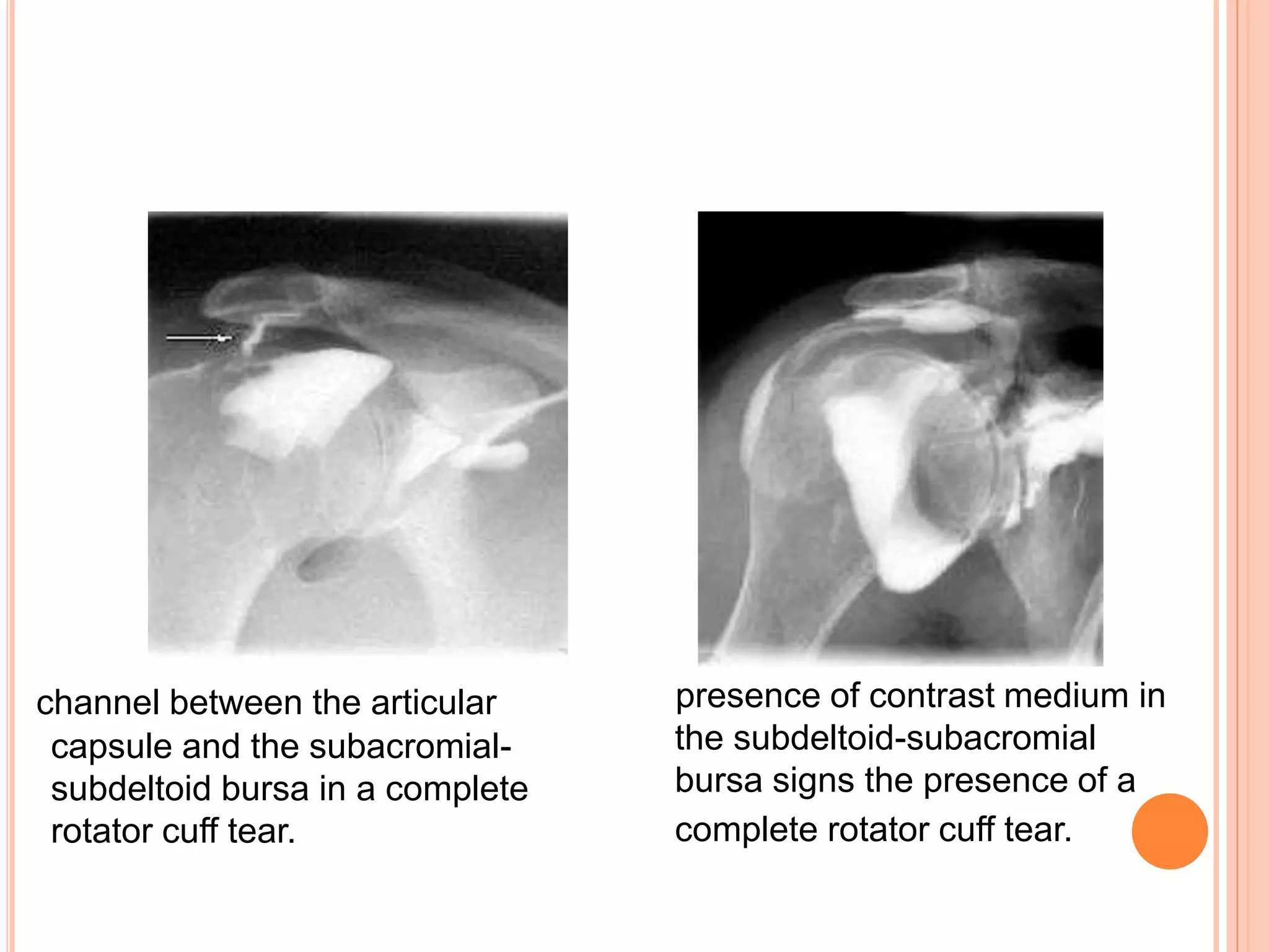 presence of contrast medium in
the subdeltoid-subacromial
bursa signs the presence of a
complete rotator cuff tear.
channel between the articular
capsule and the subacromial-
subdeltoid bursa in a complete
rotator cuff tear.
 