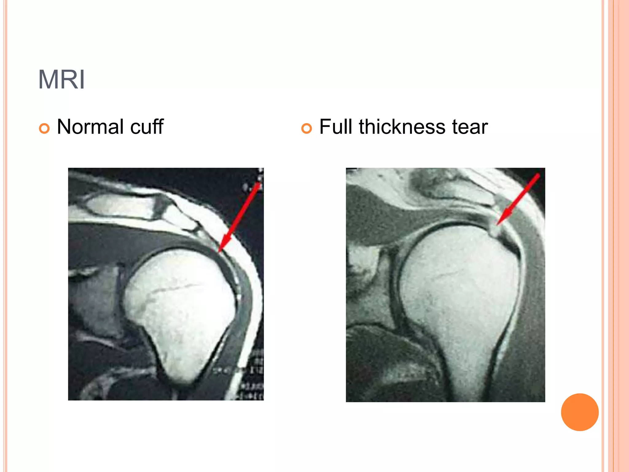 MRI
 Normal cuff  Full thickness tear
 