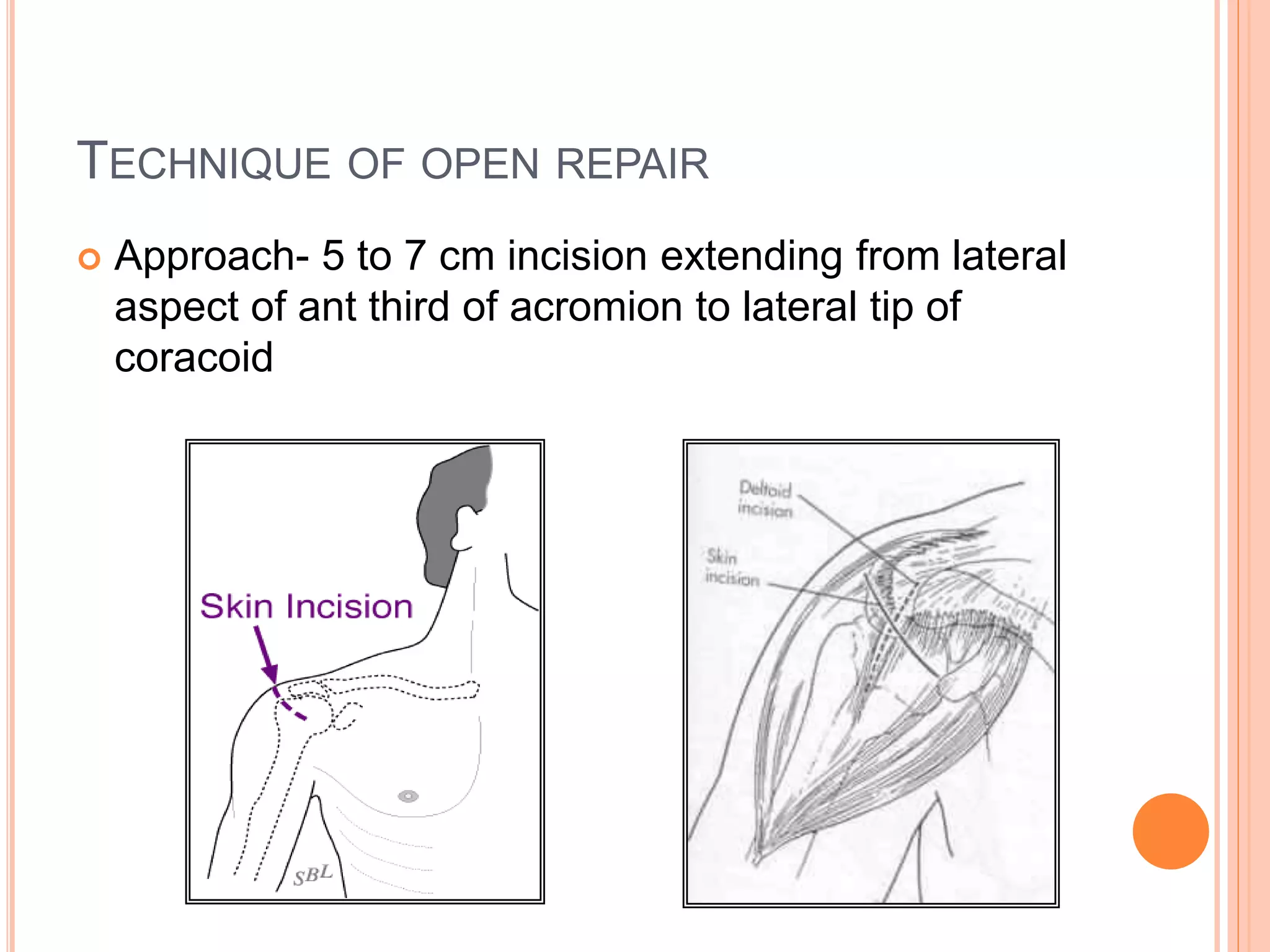 TECHNIQUE OF OPEN REPAIR
 Approach- 5 to 7 cm incision extending from lateral
aspect of ant third of acromion to lateral tip of
coracoid
 
