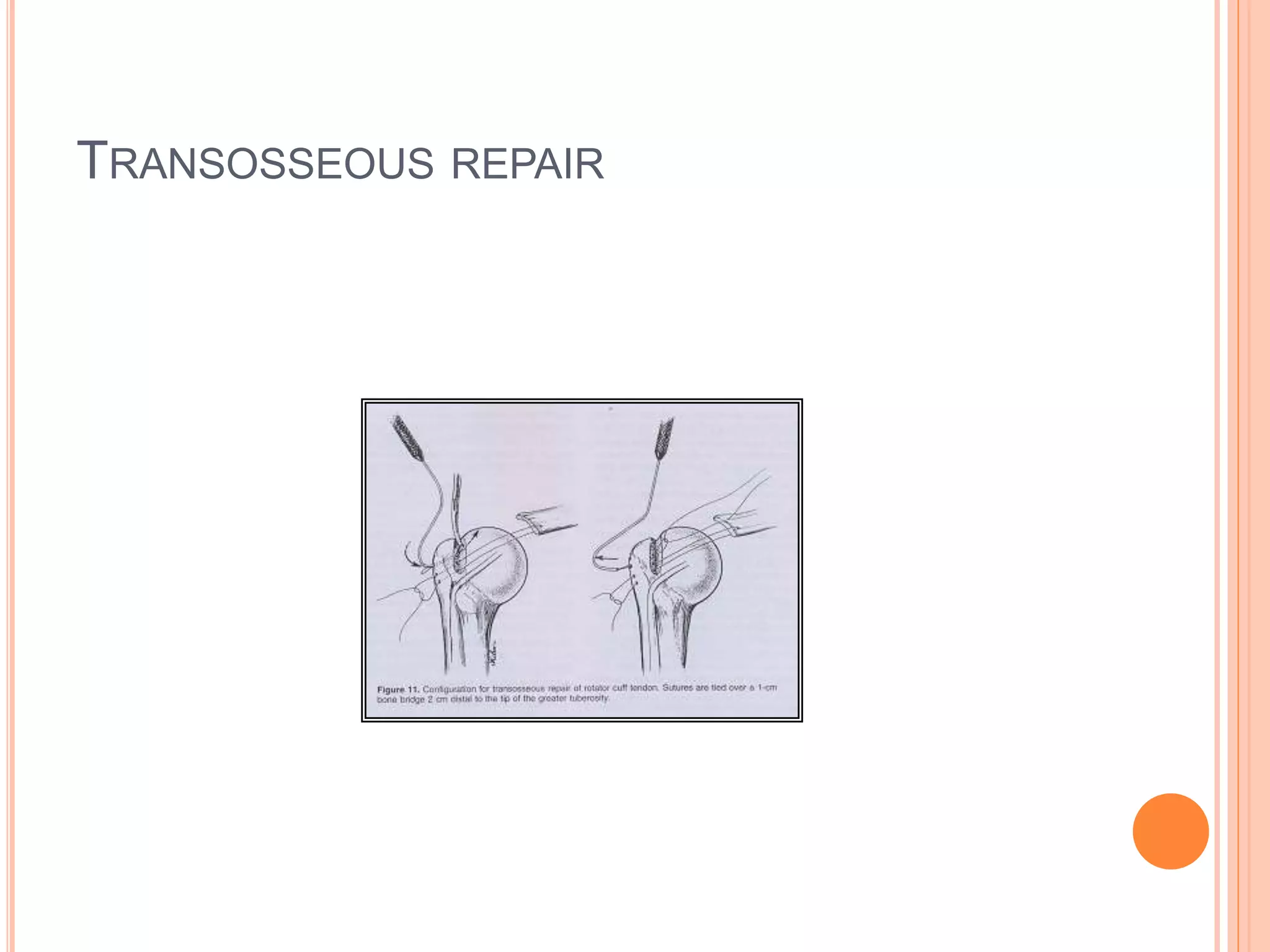TRANSOSSEOUS REPAIR
 