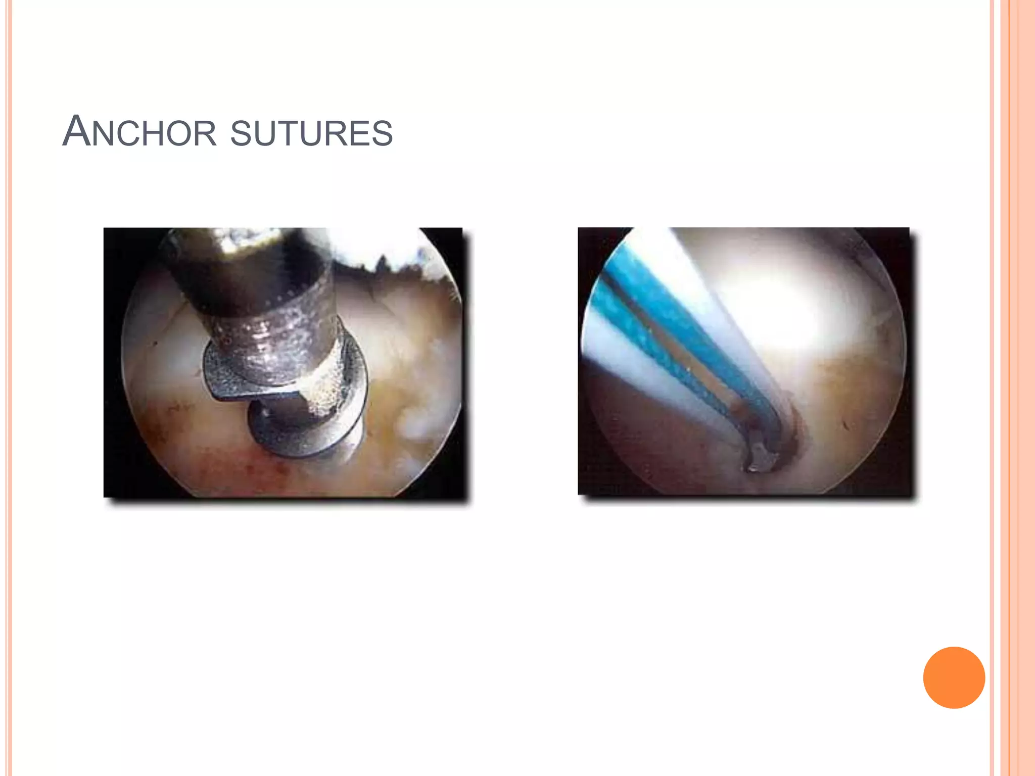 ANCHOR SUTURES
 