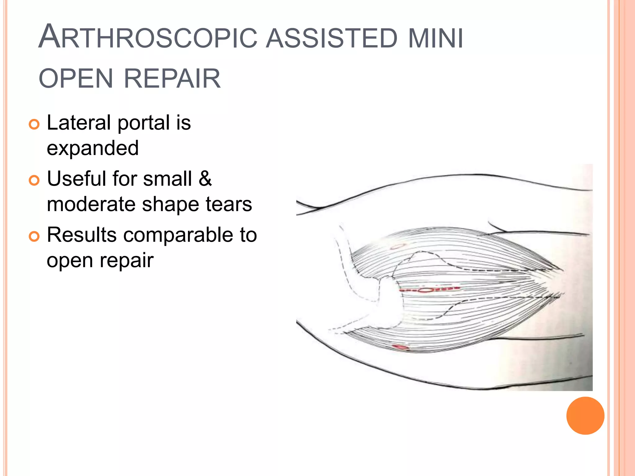 ARTHROSCOPIC ASSISTED MINI
OPEN REPAIR
 Lateral portal is
expanded
 Useful for small &
moderate shape tears
 Results comparable to
open repair
 