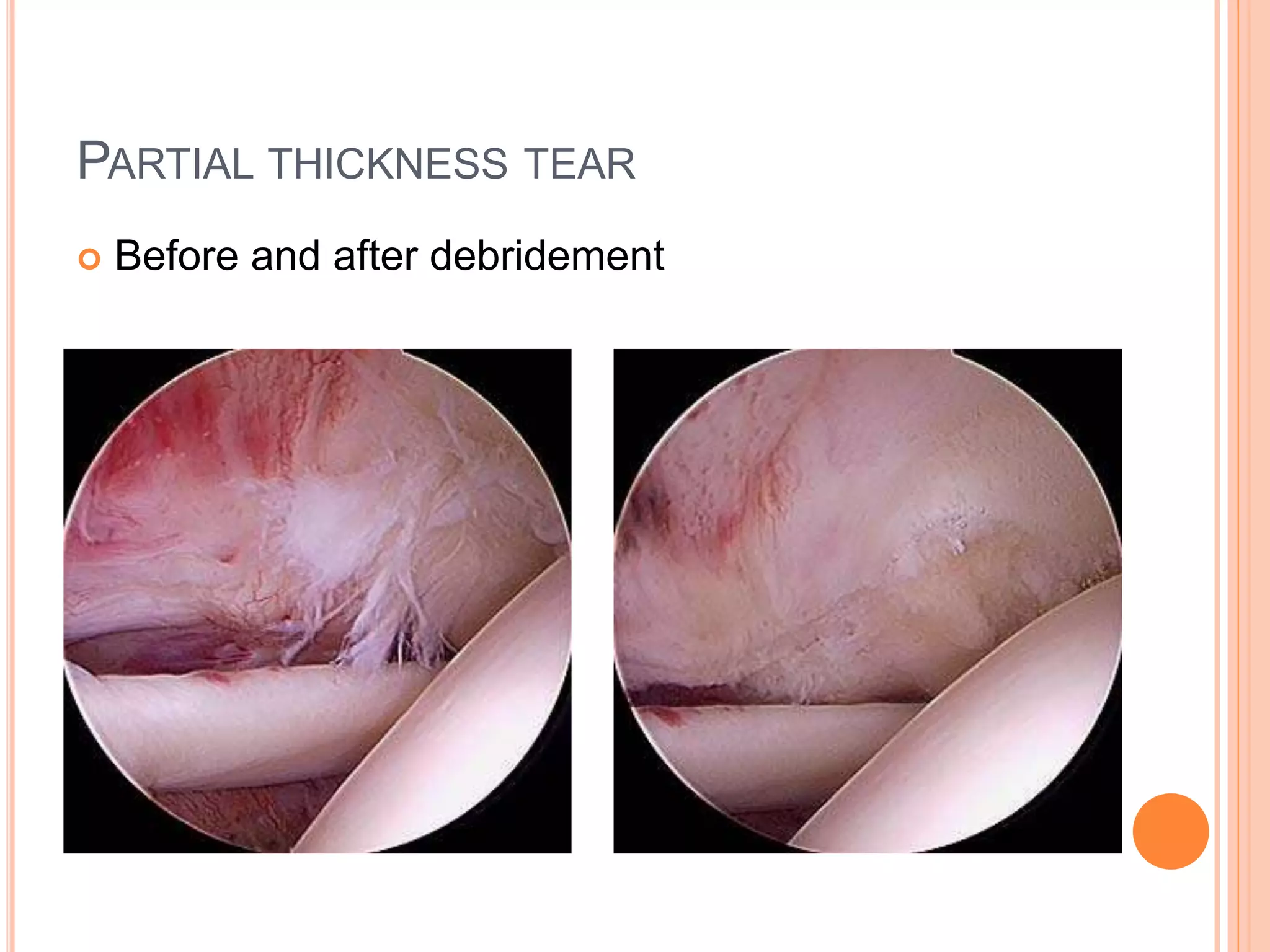 PARTIAL THICKNESS TEAR
 Before and after debridement
 