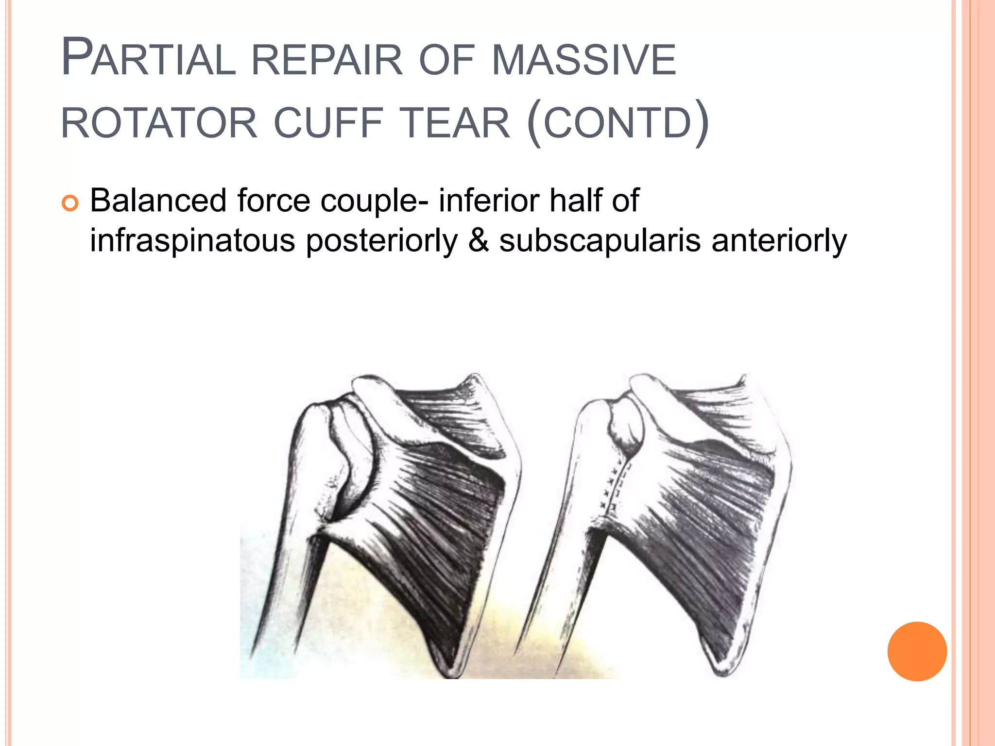 PARTIAL REPAIR OF MASSIVE
ROTATOR CUFF TEAR (CONTD)
 Balanced force couple- inferior half of
infraspinatous posteriorly & subscapularis anteriorly
 