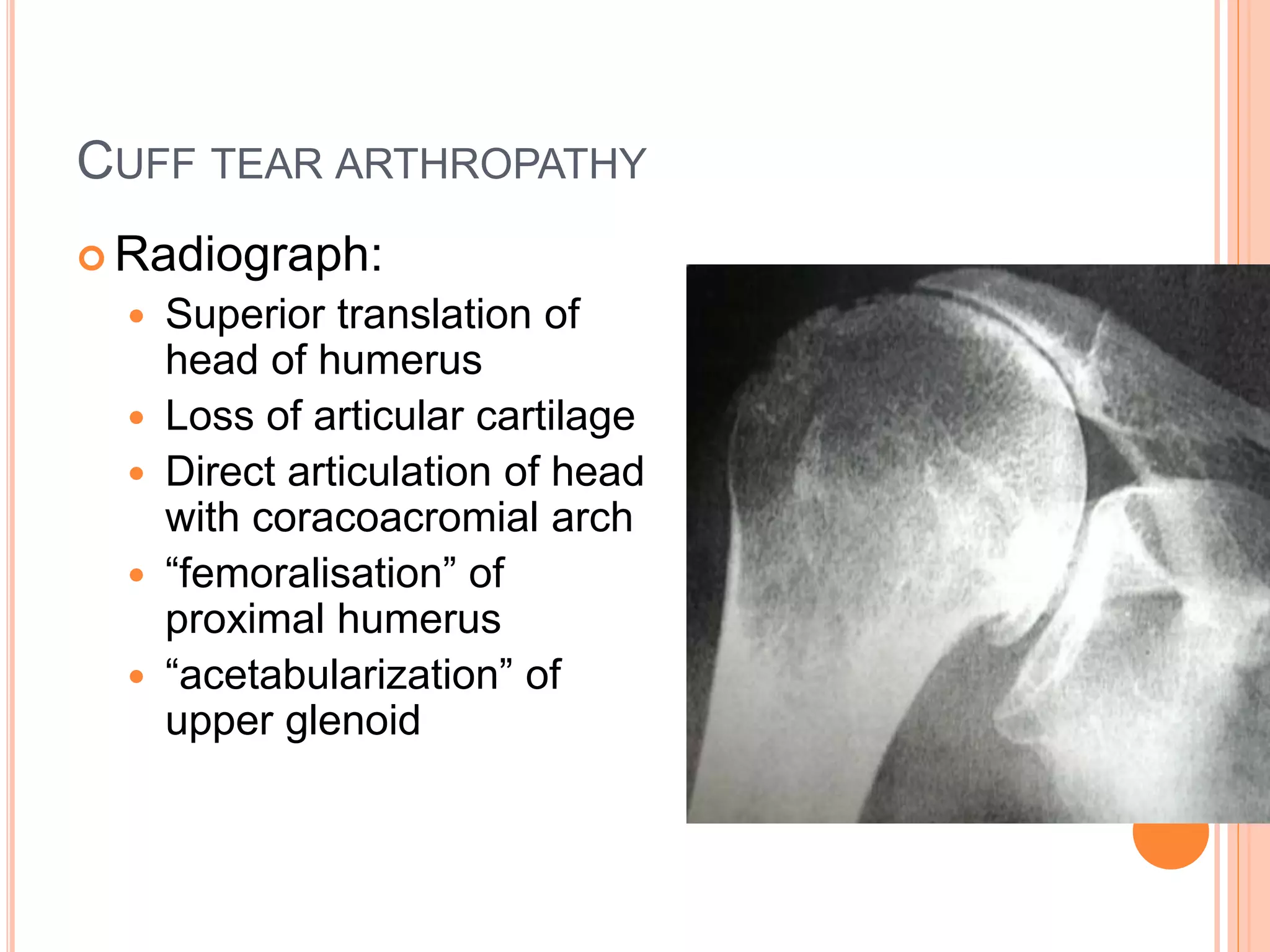 CUFF TEAR ARTHROPATHY
 Radiograph:
 Superior translation of
head of humerus
 Loss of articular cartilage
 Direct articulation of head
with coracoacromial arch
 “femoralisation” of
proximal humerus
 “acetabularization” of
upper glenoid
 