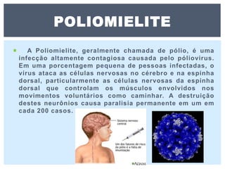  A Poliomielite, geralmente chamada de pólio, é uma
infecção altamente contagiosa causada pelo póliovirus.
Em uma porcentagem pequena de pessoas infectadas, o
vírus ataca as células nervosas no cérebro e na espinha
dorsal, particularmente as células nervosas da espinha
dorsal que controlam os músculos envolvidos nos
movimentos voluntários como caminhar. A destruição
destes neurônios causa paralisia permanente em um em
cada 200 casos.
POLIOMIELITE
 