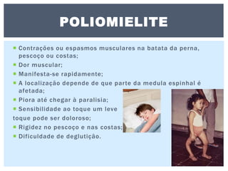  Contrações ou espasmos musculares na batata da perna,
pescoço ou costas;
 Dor muscular;
 Manifesta-se rapidamente;
 A localização depende de que parte da medula espinhal é
afetada;
 Piora até chegar à paralisia;
 Sensibilidade ao toque um leve
toque pode ser doloroso;
 Rigidez no pescoço e nas costas;
 Dificuldade de deglutição.
POLIOMIELITE
 