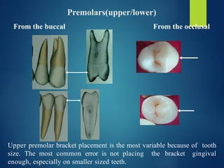 ROTH & MBT PHILOSOPHY ORTHODONTICS POWERPOINT | PPTX