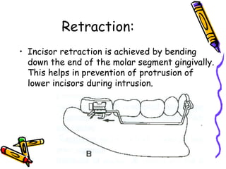 Retraction:
• Incisor retraction is achieved by bending
down the end of the molar segment gingivally.
This helps in prevention of protrusion of
lower incisors during intrusion.
 