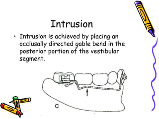 Intrusion
• Intrusion is achieved by placing an
occlusally directed gable bend in the
posterior portion of the vestibular
segment.
 