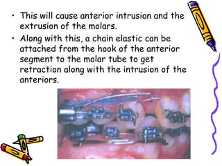• This will cause anterior intrusion and the
extrusion of the molars.
• Along with this, a chain elastic can be
attached from the hook of the anterior
segment to the molar tube to get
retraction along with the intrusion of the
anteriors.
 