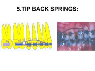 5.TIP BACK SPRINGS:
 