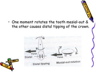 • One moment rotates the tooth mesial-out &
the other causes distal tipping of the crown.
 