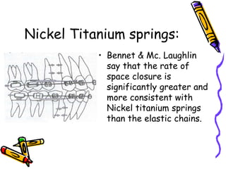 Nickel Titanium springs:
• Bennet & Mc. Laughlin
say that the rate of
space closure is
significantly greater and
more consistent with
Nickel titanium springs
than the elastic chains.
 