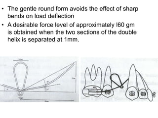 • The gentle round form avoids the effect of sharp
bends on load deflection
• A desirable force level of approximately l60 gm
is obtained when the two sections of the double
helix is separated at 1mm.
 