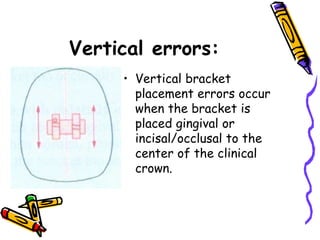 Vertical errors:
• Vertical bracket
placement errors occur
when the bracket is
placed gingival or
incisal/occlusal to the
center of the clinical
crown.
 