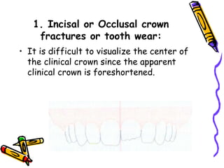 1. Incisal or Occlusal crown
fractures or tooth wear:
• It is difficult to visualize the center of
the clinical crown since the apparent
clinical crown is foreshortened.
 