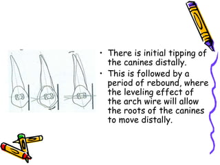 • There is initial tipping of
the canines distally.
• This is followed by a
period of rebound, where
the leveling effect of
the arch wire will allow
the roots of the canines
to move distally.
 