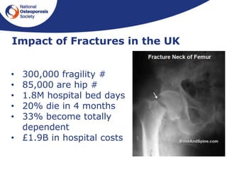 • 300,000 fragility #
• 85,000 are hip #
• 1.8M hospital bed days
• 20% die in 4 months
• 33% become totally
dependent
• £1.9B in hospital costs
Impact of Fractures in the UK
 