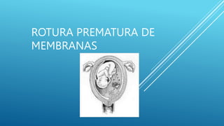 ROTURA PREMATURA DE
MEMBRANAS
 