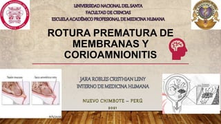 ROTURA PREMATURA DE
MEMBRANAS Y
CORIOAMNIONITIS
 