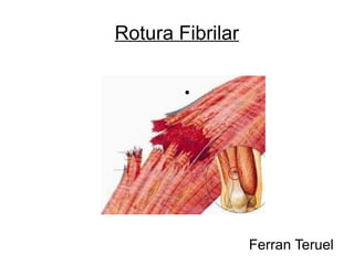 Rotura Fibrilar
●
Ferran Teruel
 