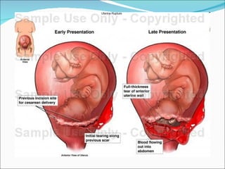 Traumatismo del canal de parto
ruptura uterina
 