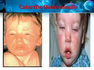 Catarrhe Oculo-nasale
 