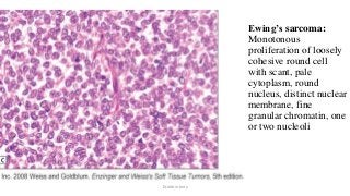 Ewing’s sarcoma:
Monotonous
proliferation of loosely
cohesive round cell
with scant, pale
cytoplasm, round
nucleus, distinct nuclear
membrane, fine
granular chromatin, one
or two nucleoli
Dr.Aldrin Jerry
 