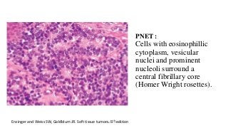 PNET :
Cells with eosinophillic
cytoplasm, vesicular
nuclei and prominent
nucleoli surround a
central fibrillary core
(Homer Wright rosettes).
Enzinger and Weiss SW, Goldblum JR. Soft tissue tumors. 5th editionDr.Aldrin Jerry
 
