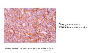 Strong membranous
CD99 immunoreactivity
Enzinger and Weiss SW, Goldblum JR. Soft tissue tumors. 5th edition
Dr.Aldrin Jerry
 