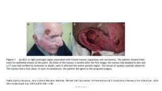 Pablo Santos Gorjóna,, Ana Cristina Morales Martínb. Merkel Cell Carcinoma: A Presentation of 5 Cases and a Review o the Literature. Acta
Otorrinolaringol Esp. 2011;62(4):306---310
Dr.Aldrin Jerry
 