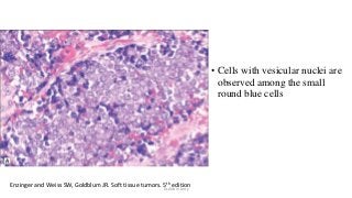 • Cells with vesicular nuclei are
observed among the small
round blue cells
Enzinger and Weiss SW, Goldblum JR. Soft tissue tumors. 5th edition
Dr.Aldrin Jerry
 
