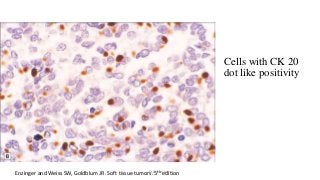 Cells with CK 20
dot like positivity
Enzinger and Weiss SW, Goldblum JR. Soft tissue tumors. 5th editionDr.Aldrin Jerry
 