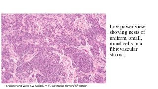 Low power view
showing nests of
uniform, small,
round cells in a
fibrovascular
stroma.
Enzinger and Weiss SW, Goldblum JR. Soft tissue tumors. 5th editionDr.Aldrin Jerry
 