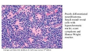 Poorly differentiated
neuroblastoma.
Small round/ ovoid
cells with
hyperchromatic
nuclei, scant
cytoplasm and
Homer Wright
rosettes
Enzinger and Weiss SW, Goldblum JR. Soft tissue tumors. 5th editionDr.Aldrin Jerry
 
