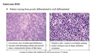 Enzinger and Weiss SW, Goldblum JR. Soft tissue tumors. 5th edition
Dr.Aldrin Jerry
 