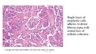 Single layer of
neoplastic cells
adheres to dense
fibrous septa with
central loss of
cellular cohesion.
Enzinger and Weiss SW, Goldblum JR. Soft tissue tumors. 5th edition
Dr.Aldrin Jerry
 