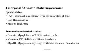 Embryonal / Alveolar Rhabdomyosarcoma
Special stains
• PAS - abundant intracellular glycogen regardless of type
• Iron Haematoxylin
• Masson Trichrome
Immunohistochemical studies
• Desmin, Myoglobin- well differentiated cells
• Vimentin, CK, S-100- undifferentiated cells
• MyoD1, Myogenin- early stage of skeletal muscle differentiation
Dr.Aldrin Jerry
 