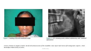 Uma K, Cherian G, Nayak V, Patil S. Small cell osteosarcoma of the mandible: Case report and review of its diagnostic aspects. J Oral
Maxillofac Pathol 2011;15:330-4.
Dr.Aldrin Jerry
 