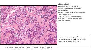 Osteosarcoma composed
predominantly of small round cells
adjacent to bands of osteoid
Microscopically
Small cells identical in size to
Ewing/PNET cells and a lace-like
osteoid stroma.
Majority - round tumor cells; rare cases
- short spindle cells
Cytoplasm – scant; Nuclei - round to
oval, fine to coarse chromatin, show
abundant mitoses.
Enzinger and Weiss SW, Goldblum JR. Soft tissue tumors. 5th edition
Dr.Aldrin Jerry
 