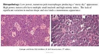 Histopathology: Low power, numerous pale macrophages producing a “starry sky” appearance.
High power, tumor cells have multiple small nucleoli and high mitotic index. The lack of
significant variation in nuclear shape and size lends a monotonous appearance
Enzinger and Weiss SW, Goldblum JR. Soft tissue tumors. 5th edition
Dr.Aldrin Jerry
 