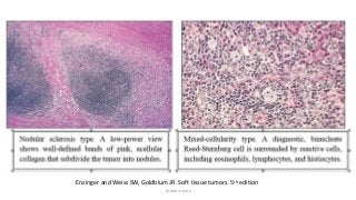 Enzinger and Weiss SW, Goldblum JR. Soft tissue tumors. 5th edition
Dr.Aldrin Jerry
 