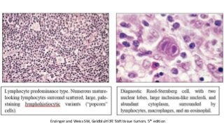 Enzinger and Weiss SW, Goldblum JR. Soft tissue tumors. 5th editionDr.Aldrin Jerry
 