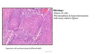 Histology:
-Sheets of cells
-Pleomorphism & hyperchromatism
with many mitotic figures
• -
Squamous cell carcinoma (poorly differentiated)
Dr.Aldrin Jerry
 