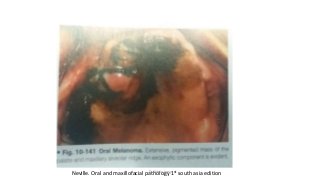 Neville. Oral and maxillofacial pathology 1st south asia editionDr.Aldrin Jerry
 