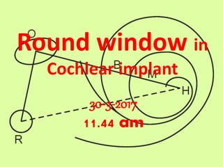 Round window in
Cochlear implant
10-4-2017
11.33 am
 